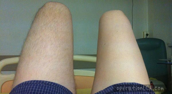jambe rasée avant opération