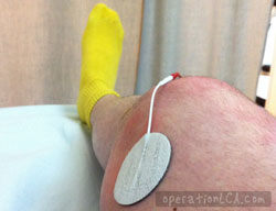 électrode d'électrostimulateur pour quadriceps